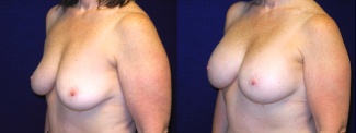 Left 3/4 View - Breast Augmentation After Weight Loss - Silicone Implants