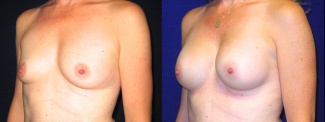 Left 3/4 View - Breast Augmentation After Pregnancy - Silicone Implants