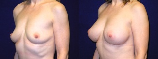 Left 3/4 View - Breast Augmentation - Silicone Implants