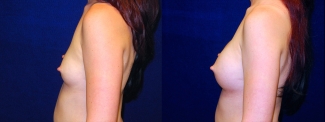Left Profile View Breast Augmentation - Breast Asymmetry