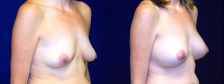 Right 3/4 View - Breast Augmentation After Pregnancy - Silicone Implants