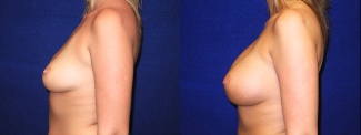 Left Profile View - Breast Augmentation - Silicone Implants