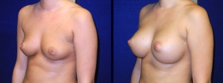 Left 3/4 View - Breast Augmentation - Silicone Implants