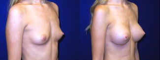 Right 3/4 View - Breast Augmentation - Silicone Implants