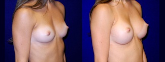 Right 3/4 View - Breast Augmentation - Silicone Implants