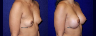Right 3/4 View - Breast Augmentation - Breast Asymmetry Correction