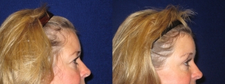 Right Profile View - Browlift with Upper Eyelid Surgery