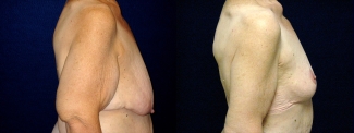 Right Profile View - Breast Reduction Mastopexy and Arm Lift After Massive Weight Loss