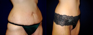 Right 3/4 View - Circumferential Abdominoplasty After Massive Weight Loss