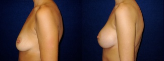 Left Profile View - Breast Augmentation - Silicone Implants