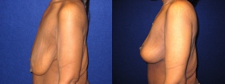 Left Profile View - Breast Lift and Arm Lift After Massive Weight Loss