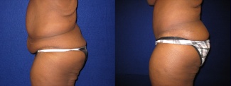 Left Profile View - Tummy Tuck After Massive Weight Loss
