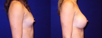 Right Profile View - Breast Augmentation - Silicone Implants