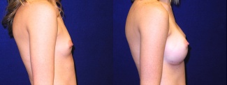 Right Profile View - Breast Augmentation - Silicone Implants