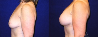 Left Profile View - Breast Augmentation After Weight Loss - Silicone Implants