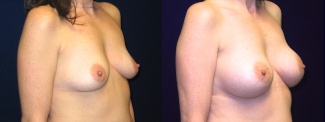 Right 3/4 View - Breast Augmentation After Pregnancy - Silicone Implants