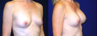 Right 3/4 View - Breast Augmentation After Pregnancy - Silicone Implants