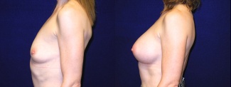 Left Profile View - Breast Augmentation - Silicone Implants