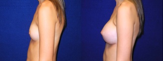 Left Profile View - Breast Augmentation - Silicone Implants