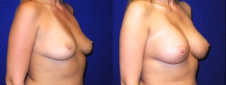 Right 3/4 View - Breast Augmentation - Silicone Implants