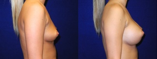 Right Profile View - Breast Augmentation - Silicone Implants