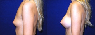 Left Profile View - Breast Augmentation - Silicone Implants