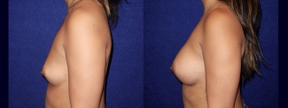 Left Profile View - Breast Augmentation - Breast Asymmetry Correction