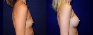 Right Profile View - Breast Augmentation - Silicone Implants