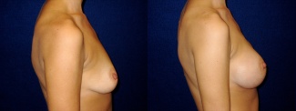 Right Profile View - Breast Augmentation - Silicone Implants