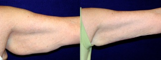 Frontal View - Left Arm - Arm Lift