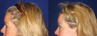 Left Profile View - Browlift with Upper Eyelid Surgery