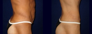 Right Profiile View - Tummy Tuck After Massive Weight Loss