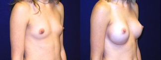 Right 3/4 View - Breast Augmentation - Silicone Implants