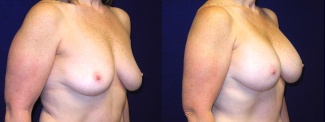 Right 3/4 View - Breast Augmentation After Weight Loss - Silicone Implants