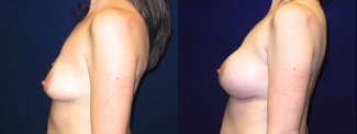 Right Profile View - Breast Augmentation After Pregnancy - Silicone Implants