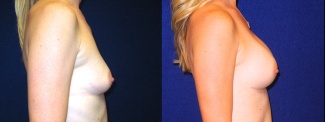 Right Profile View - Breast Augmentation After Pregnancy - Silicone Implants