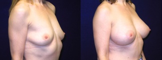 Right 3/4 View - Breast Augmentation - Silicone Implants