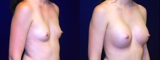 Right 3/4 View Breast Augmentation - Breast Asymmetry