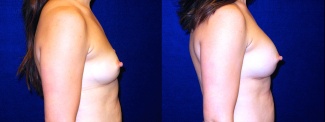 Right Profile View - Breast Augmentation - Silicone Implants