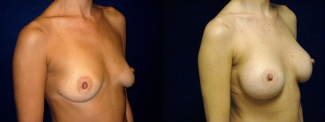 Right 3/4 View - Breast Augmentation - Silicone Implants