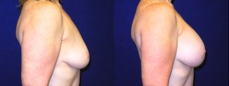 Right Profile View - Breast Augmentation After Weight Loss - Silicone Implants