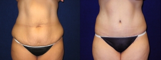 Frontal View - Abdominoplasty After Massive Weight Loss