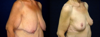 Right 3/4 View - Breast Reduction Mastopexy and Arm Lift After Massive Weight Loss