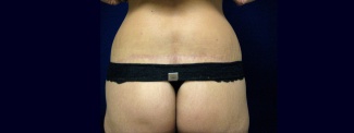Back View After - Circumferential Abdominoplasty After Massive Weight Loss