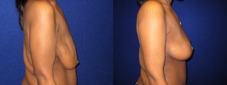 Right Profile View - Breast Lift and Arm Lift After Massive Weight Loss