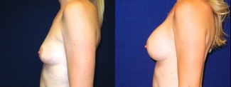 Left Profile View - Breast Augmentation After Pregnancy - Silicone Implants