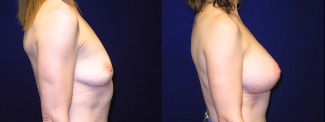 Right Profile View - Breast Augmentation - Silicone Implants