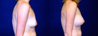 Right Profile View - Breast Augmentation After Pregnancy - Silicone Implants