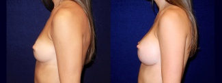 Left Profile View - Breast Augmentation - Silicone Implants