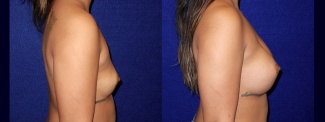 Right Profile View - Breast Augmentation - Breast Asymmetry Correction